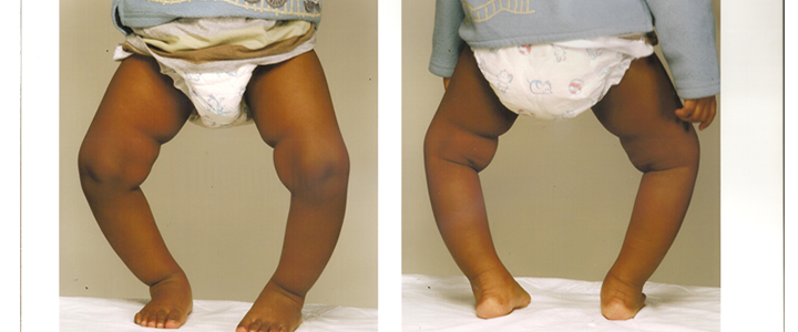 Treatment of Bow Legs in Children
