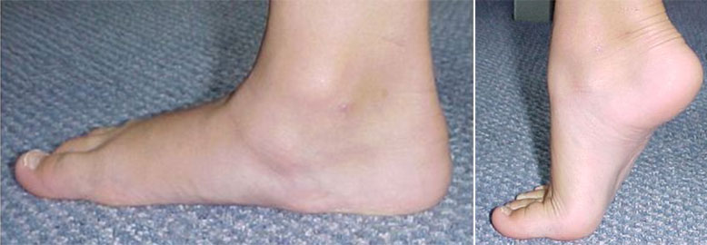 flat feet treatment in children